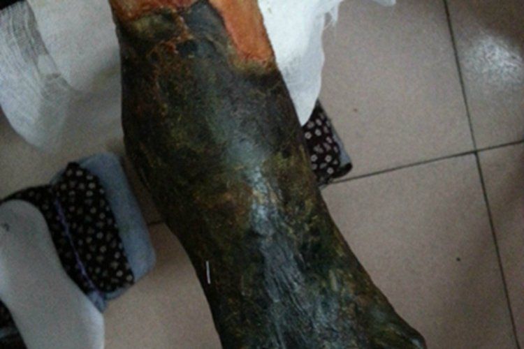 細(xì)菌感染型發(fā)黑有哪些特點(diǎn)，細(xì)菌感染型發(fā)黑