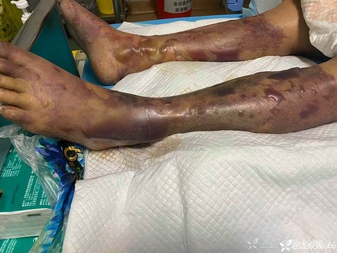 請提供一張關于感染海里細菌的圖片，感染海里細菌后如何治療