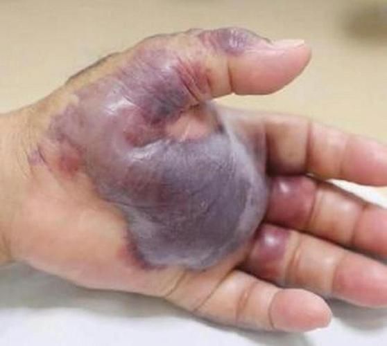 請提供一張關于感染海里細菌的圖片，感染海里細菌后如何治療