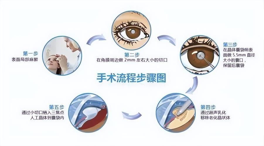 治療蒙眼病需要多長時間，三甲醫院眼科專家治療“蒙眼病”需要多長時間和配圖