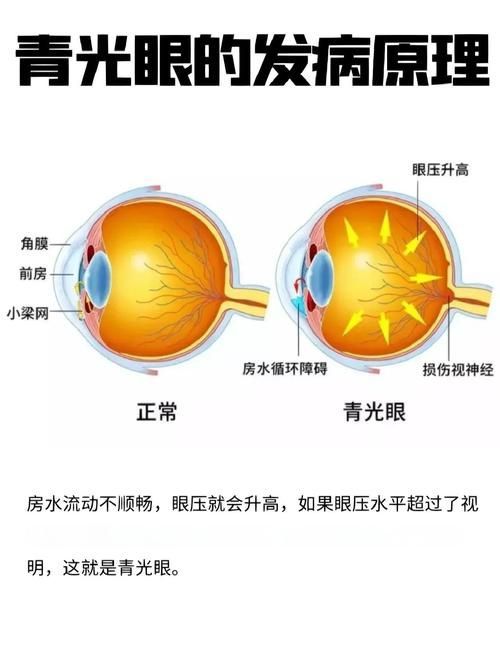 治療蒙眼病需要多長時間，三甲醫院眼科專家治療“蒙眼病”需要多長時間和配圖
