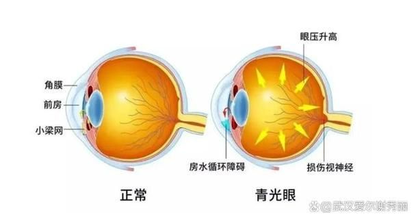 治療蒙眼病需要多長時間，三甲醫院眼科專家治療“蒙眼病”需要多長時間和配圖