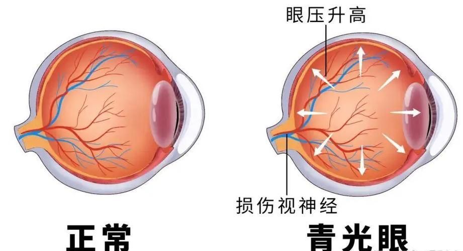 治療蒙眼病需要多長時間，三甲醫院眼科專家治療“蒙眼病”需要多長時間和配圖