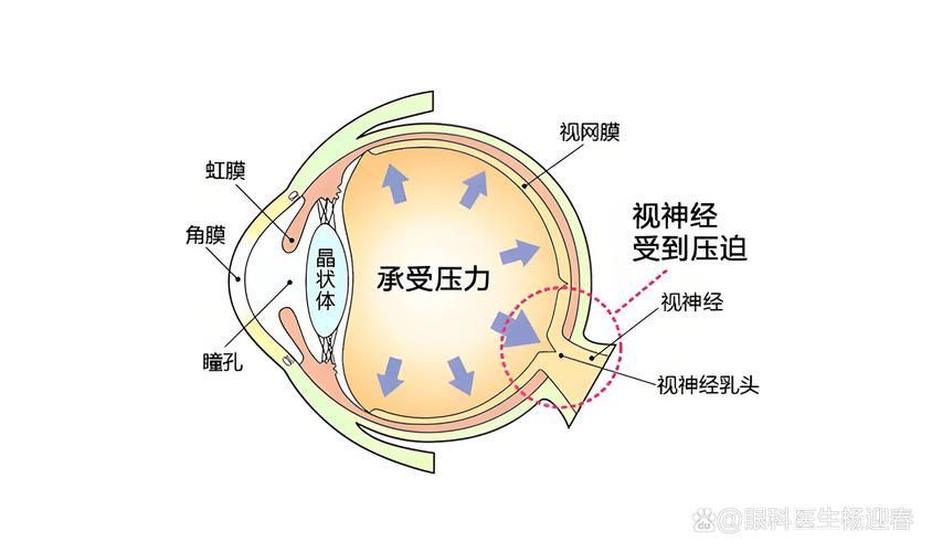 治療蒙眼病需要多長時間，三甲醫院眼科專家治療“蒙眼病”需要多長時間和配圖