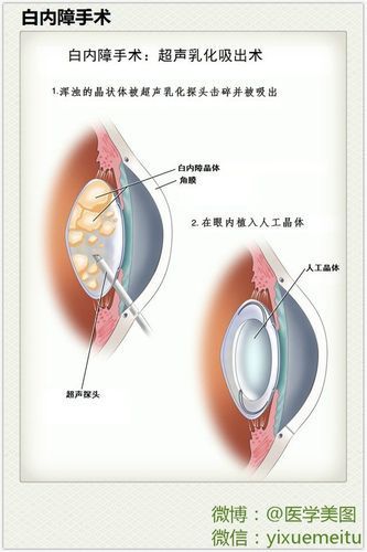 治療蒙眼病需要多長時間，三甲醫院眼科專家治療“蒙眼病”需要多長時間和配圖