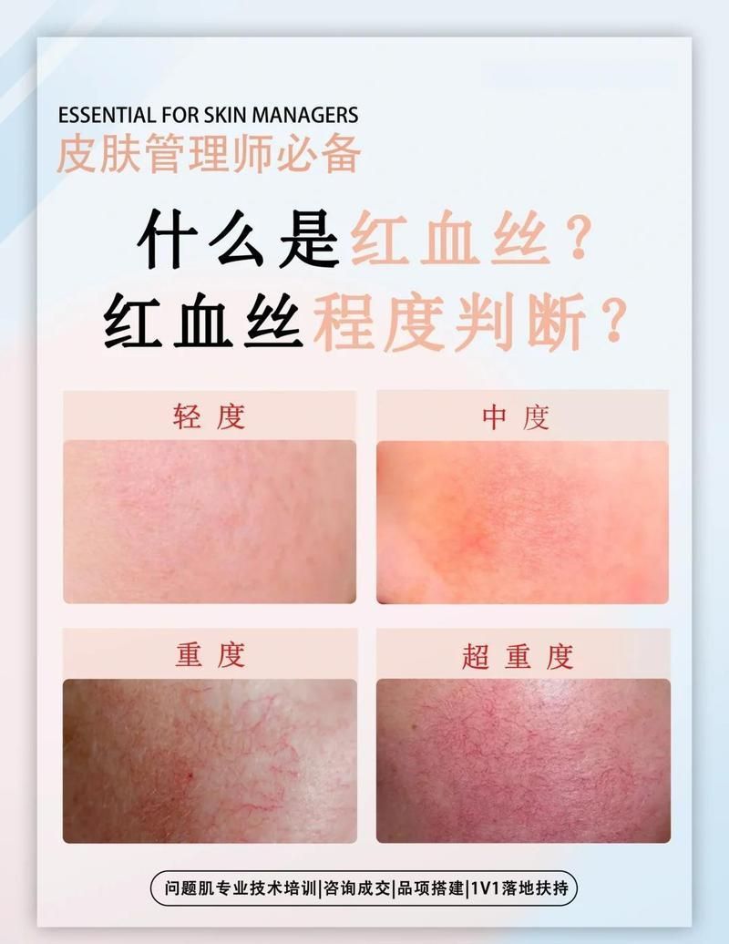如何判斷紅血絲是否嚴(yán)重，如何判斷紅血絲嚴(yán)重
