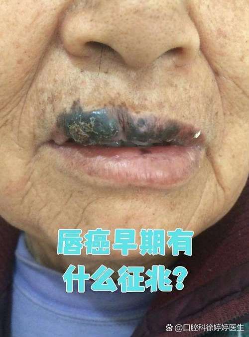 如何判斷龍魚(yú)嘴上長(zhǎng)的是不是癌？，如何判斷龍魚(yú)嘴上長(zhǎng)癌