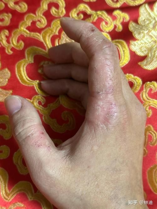 給我一些真菌感染的圖片示例，甲真菌病的自測清單
