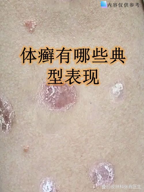 給我一些真菌感染的圖片示例，甲真菌病的自測清單