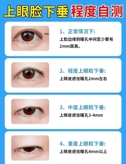 如何判斷自己是否掉眼，如何判斷上瞼下垂