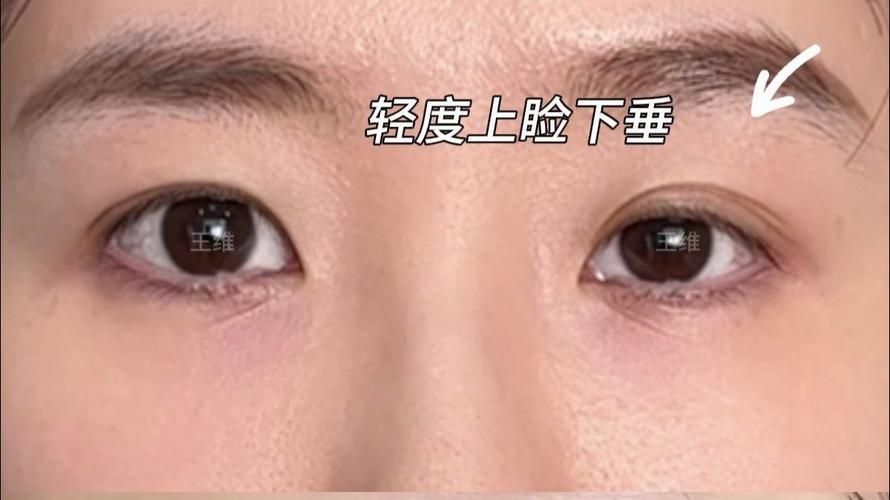 如何判斷自己是否掉眼，如何判斷上瞼下垂