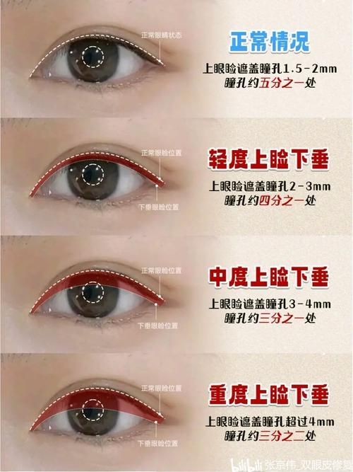 如何判斷自己是否掉眼，如何判斷上瞼下垂