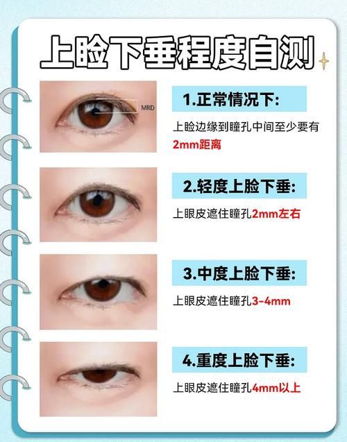 如何判斷自己是否掉眼，如何判斷上瞼下垂