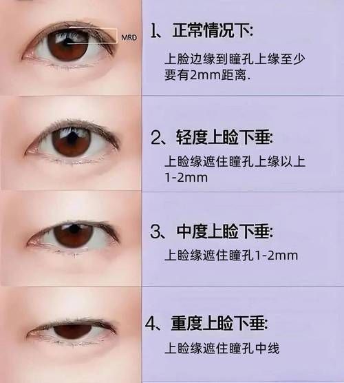 如何判斷自己是否掉眼，如何判斷上瞼下垂
