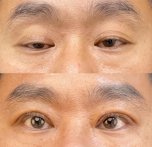 如何判斷自己是否掉眼，如何判斷上瞼下垂