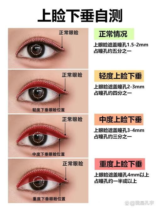 如何判斷自己是否掉眼，如何判斷上瞼下垂