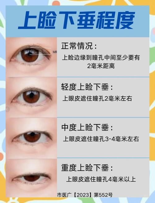 如何判斷自己是否掉眼，如何判斷上瞼下垂