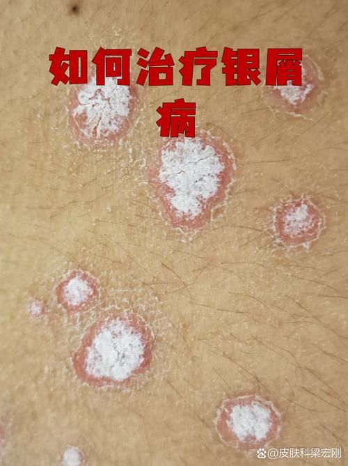 如何判斷炸鱗病是否復(fù)發(fā)，如何判斷銀屑病復(fù)發(fā)