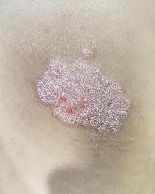 如何判斷炸鱗病是否復發，如何判斷銀屑病復發