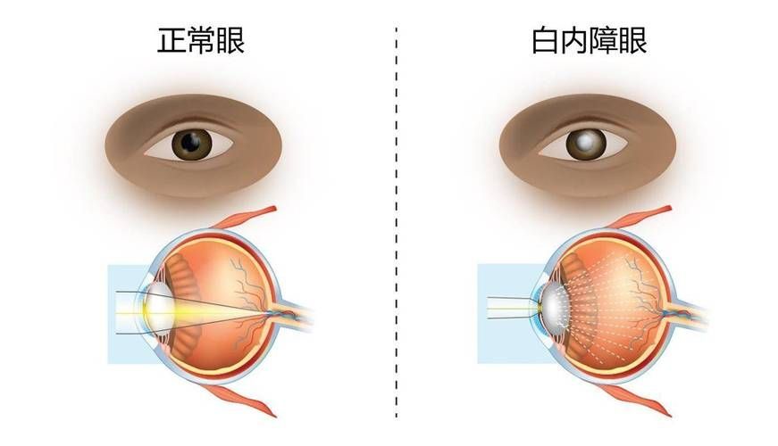蒙眼病有哪些癥狀，“蒙眼病”有哪些癥狀用戶要求詳細解釋“蒙眼病”的癥狀