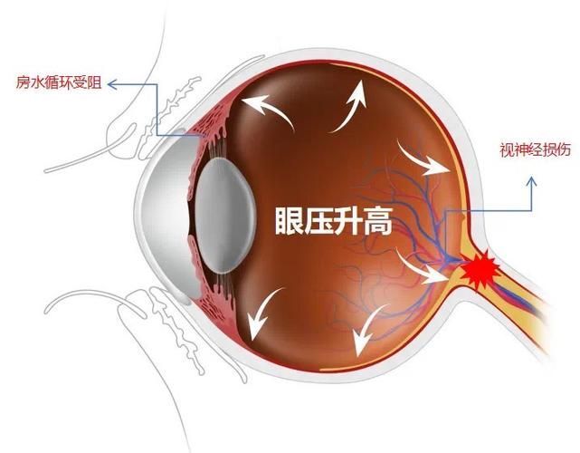 蒙眼病有哪些癥狀，“蒙眼病”有哪些癥狀用戶要求詳細解釋“蒙眼病”的癥狀