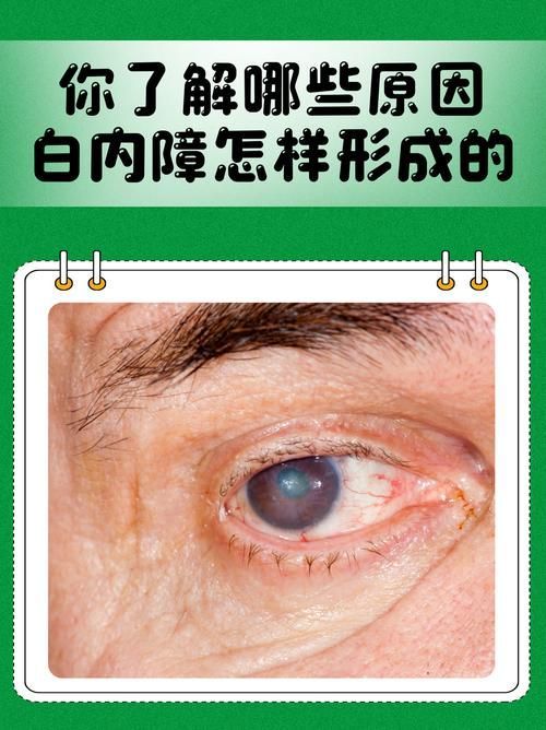 蒙眼病有哪些癥狀，“蒙眼病”有哪些癥狀用戶要求詳細解釋“蒙眼病”的癥狀