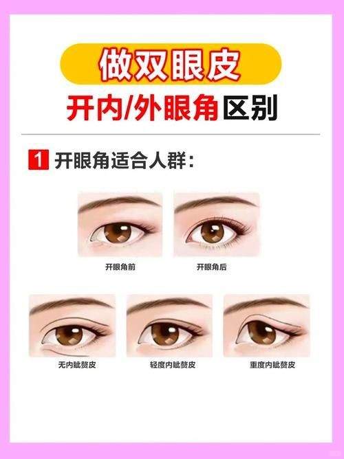 如何區(qū)分外蒙眼和內(nèi)蒙眼，“內(nèi)蒙眼”并非標(biāo)準(zhǔn)醫(yī)學(xué)術(shù)語(yǔ)