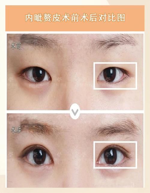 如何區(qū)分外蒙眼和內(nèi)蒙眼，“內(nèi)蒙眼”并非標(biāo)準(zhǔn)醫(yī)學(xué)術(shù)語(yǔ)