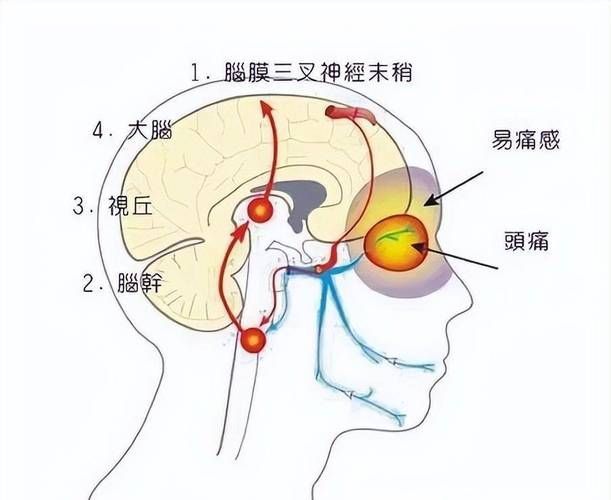 哪種治療方法最適合我，中華醫學會《中國偏頭痛診斷與治療指南》1000字詳解