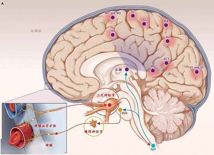 哪種治療方法最適合我，中華醫學會《中國偏頭痛診斷與治療指南》1000字詳解