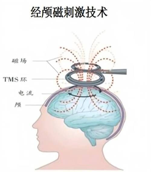 哪種治療方法最適合我，中華醫學會《中國偏頭痛診斷與治療指南》1000字詳解