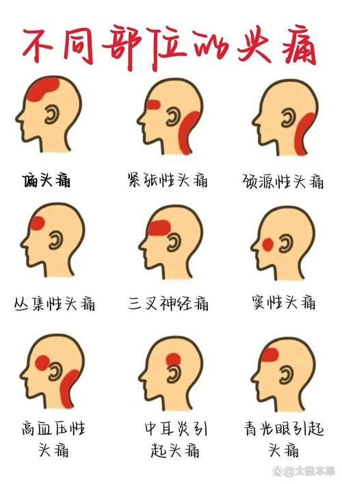 哪種治療方法最適合我，中華醫學會《中國偏頭痛診斷與治療指南》1000字詳解
