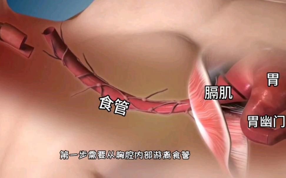 能詳細(xì)解釋每個(gè)手術(shù)步驟的含義嗎，微創(chuàng)腹腔鏡膽囊切除手術(shù)