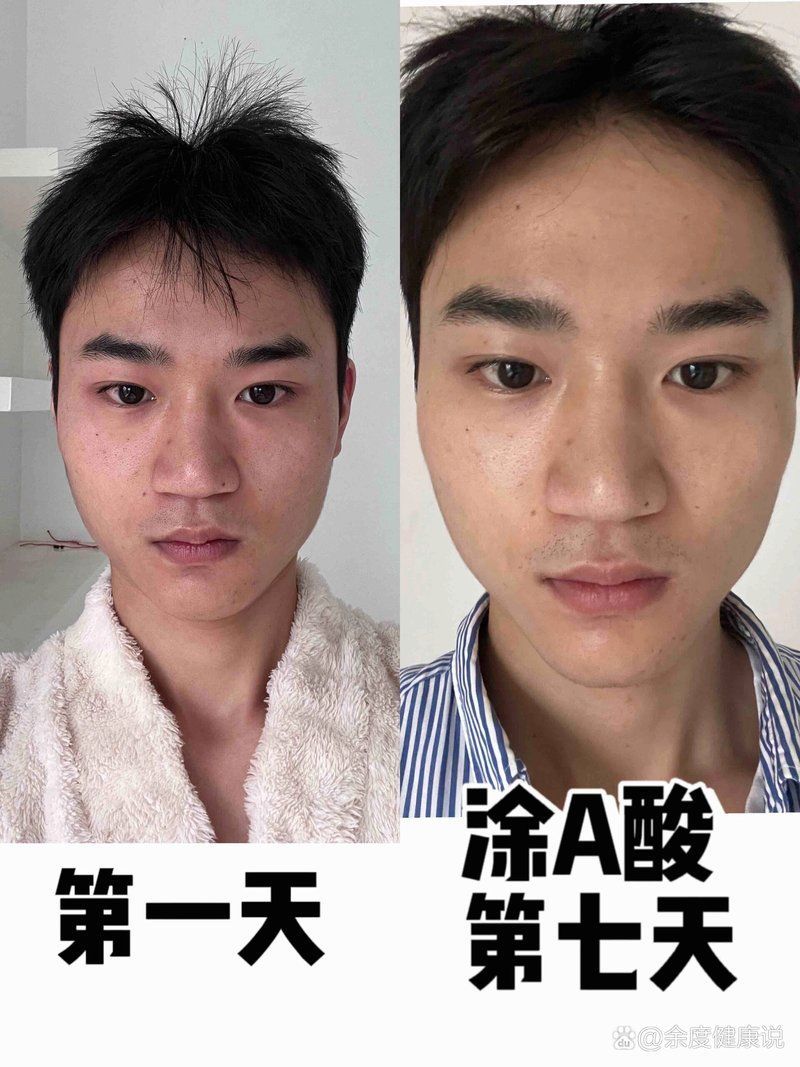 刷酸后多久見效，刷酸后多久可以化妝