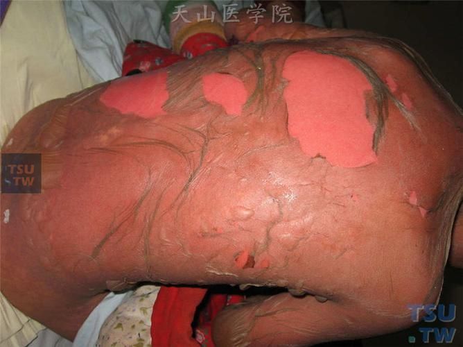 爛身病有哪些癥狀，\
