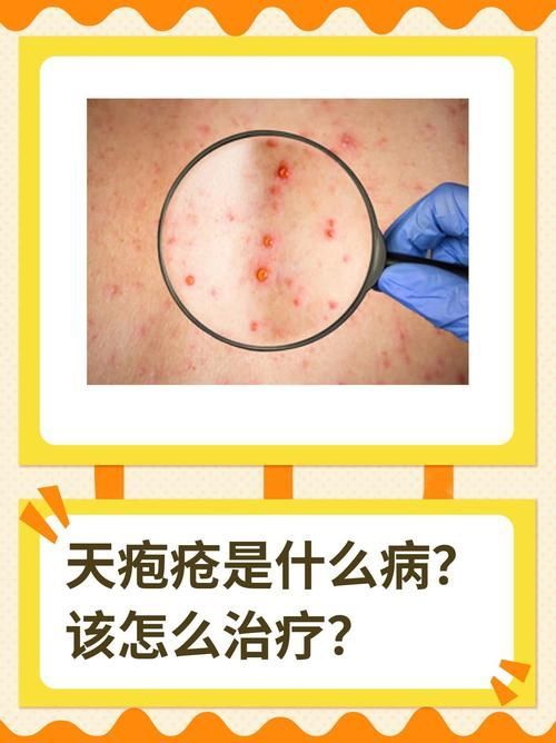 爛身病有哪些癥狀，\