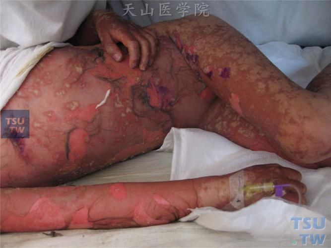 爛身病有哪些癥狀，\