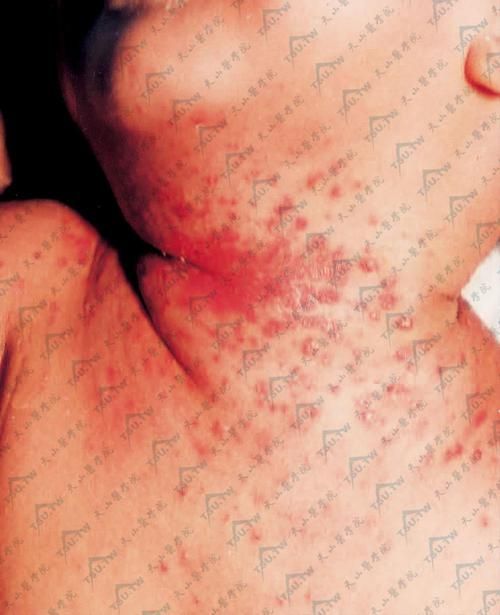 詳細(xì)介紹幾種常見(jiàn)的爛身病病原體，“爛身病”是一種由多種常見(jiàn)的爛身病原體引起的疾病