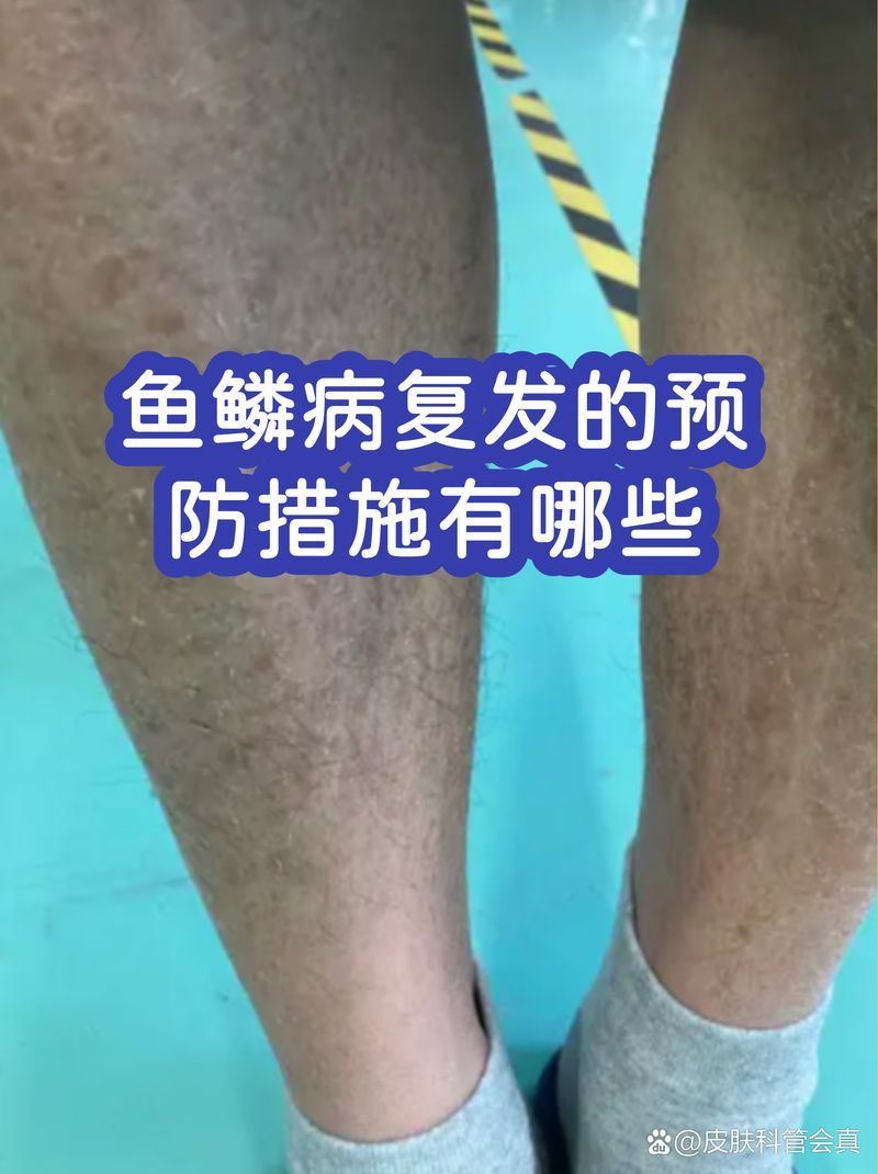 如何預(yù)防魚(yú)鱗腐爛復(fù)發(fā)，如何預(yù)防魚(yú)鱗病復(fù)發(fā)