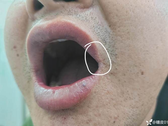 如何治療魚嘴凸起白色包，如何治療“魚嘴凸起白色包”
