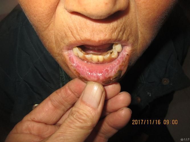 如何治療魚嘴凸起白色包，如何治療“魚嘴凸起白色包”