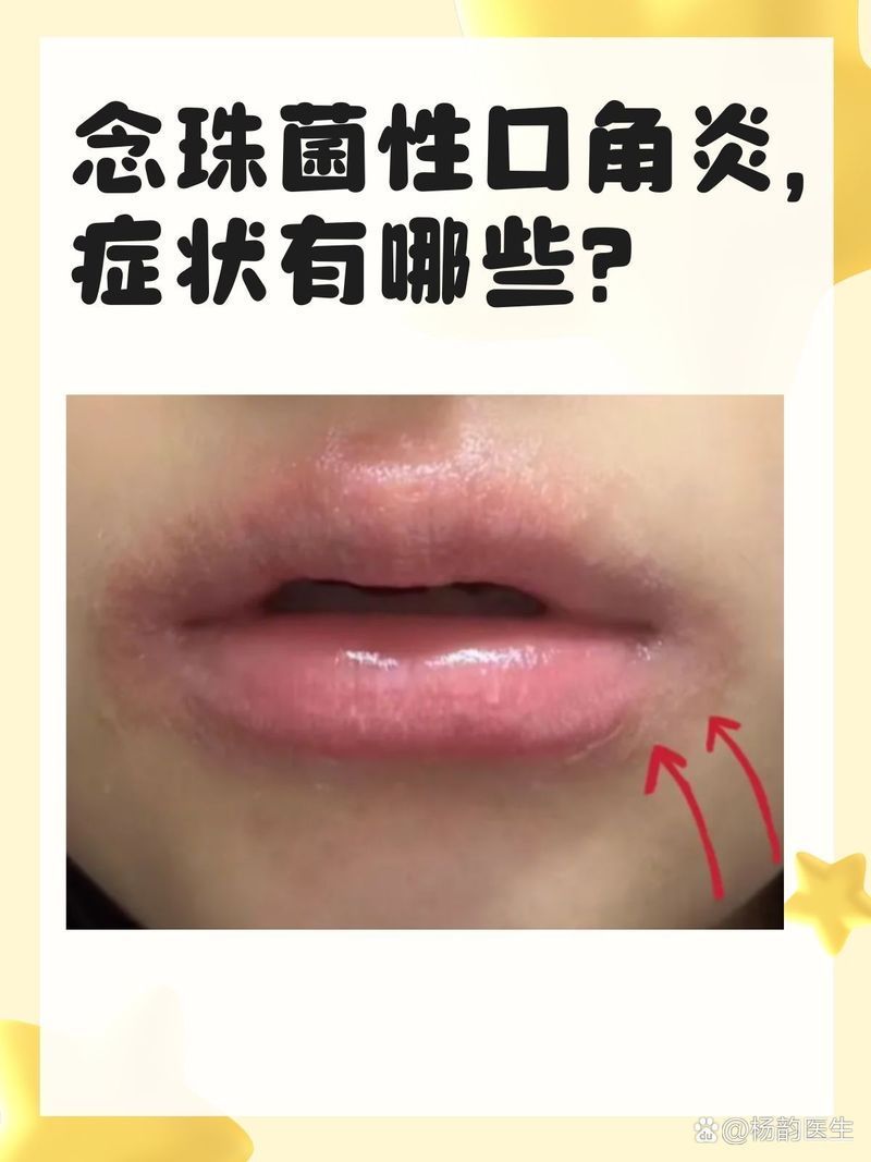 如何治療魚嘴凸起白色包，如何治療“魚嘴凸起白色包”