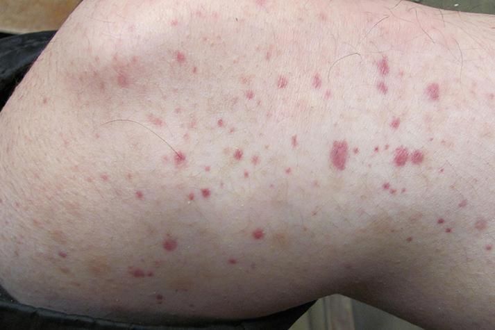 如何區分物理損傷和細菌性出血病，如何區分物理損傷與細菌性出血病