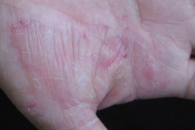 如何判斷手部是否感染真菌