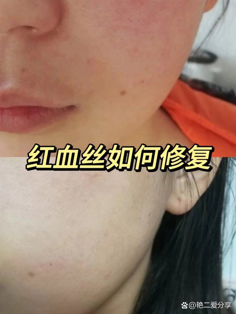 有哪些方法可以去除紅血絲，如何去除紅血絲