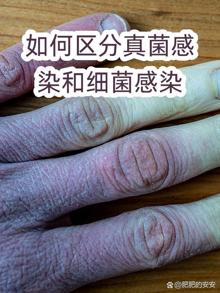 如何區分真菌和細菌感染的癥狀，區分真菌和細菌感染的癥狀對于正確診斷疾病至關重要