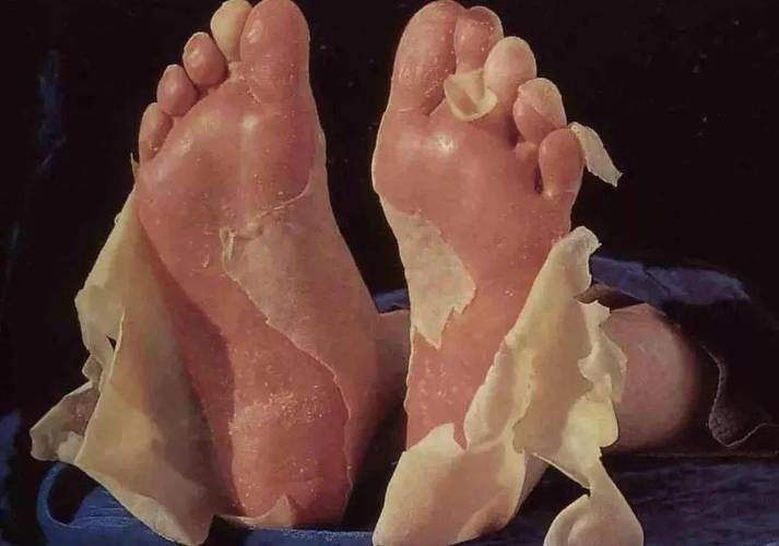 魚鱗病和松鱗病哪個更難治療