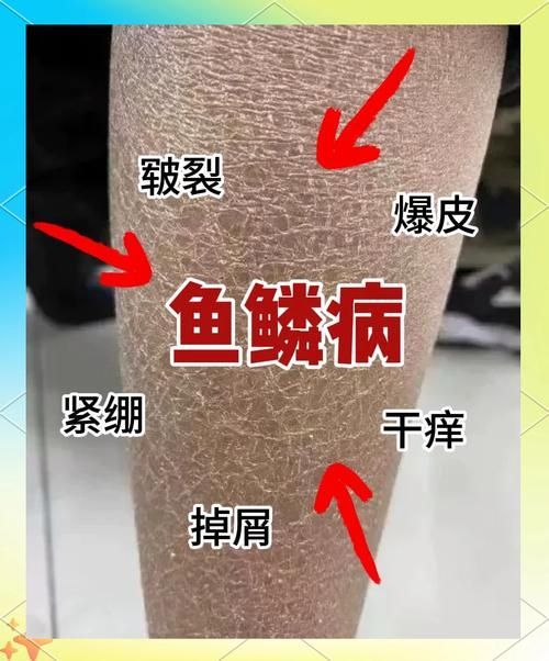 魚鱗腐爛最快解決方法，浴鱗腐爛最快解決方法