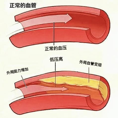 有哪些常見疾病及其防治方法，中國人群高發(fā)、具有明確防治路徑的五大類常見疾病