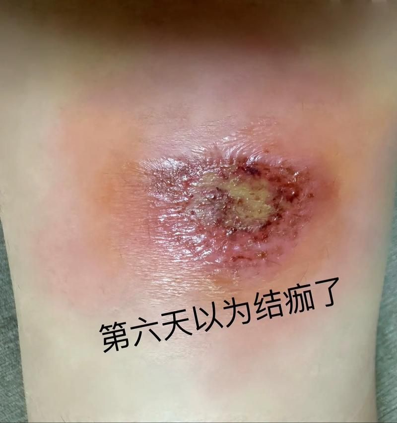 傷口感染后如何治療，傷口感染后的處理